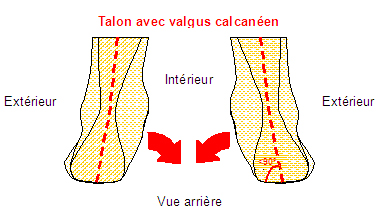 Pathologies Valgus calcan en